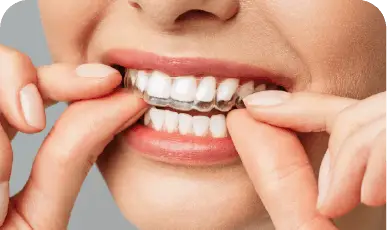 alinhadores-invisalign